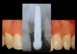 Cắm ghép nha khoa (Implant)