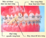 Nắn chỉnh răng tuổi nào tốt nhất.